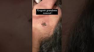 Pyogenic granuloma removalPyogenic granulomaco2laserlaser treatmentlaserdermatologist Surat [upl. by Jermaine]