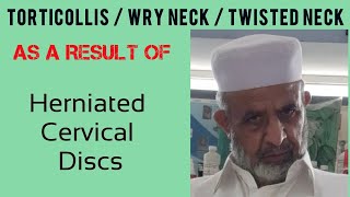 TORTICOLLISWry neck  Cervical Discs Herniation  Examination  Cervical DystoniaTWSTRS Scale [upl. by Oigufer]