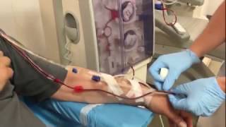 Dialysis connection of a patient with an arteriovenous fistula [upl. by Abixah418]