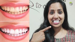 Teeth Whitening  Malayalam  പല്ലുകൾ എളുപ്പത്തിൽ വെളുക്കാൻ [upl. by Adnalor]