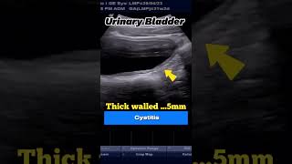 Ultrasound Cystitis of 21yrs Boy with Residual Urine [upl. by Lennaj]