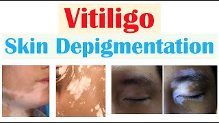 Vitiligo Skin Depigmentation  Pathophysiology Signs and Symptoms Diagnosis Treatment [upl. by Anthia225]