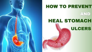 How to Prevent and Heal Stomach Ulcers [upl. by Ynnaj]