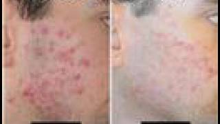 Acne Scars Acne 6 [upl. by Gert491]