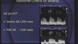 Echocardiography On Valvular Heart Diseases3 [upl. by Holmes569]