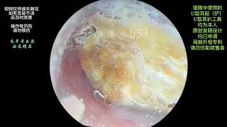 采耳哥The ear canal is blocked by large pieces of fungal earwax for cleaning [upl. by Schweiker]