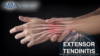 AOA Orthopedic Specialists  Extensor Tendinitis [upl. by Larson]