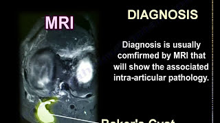 Bakers Cyst  Everything You Need To Know  Dr Nabil Ebraheim [upl. by Anu]