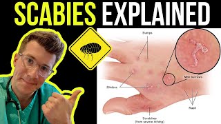 Doctor explains SCABIES skin rash including SYMPTOMS PHOTOS OF SKIN TREATMENT amp more [upl. by Ihsir]