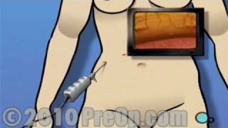 Laparoscopy Diagnostic PreOp® Patient Education [upl. by Eniamsaj]