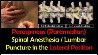 quotHowToquot Guide  Paraspinous Lumbar Puncture  Spinal Anesthesia Lateral Position [upl. by Melany995]