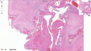 Infective Endocarditis  Histopathology [upl. by Servetnick]