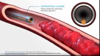 JETi Hydrodynamic Thrombectomy System Method of Action MOA Animation [upl. by Mcfadden243]