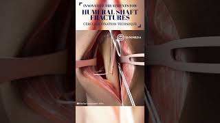 Innovative Treatment for Humerus Fracture medical shorts tech suture science animation learn [upl. by Aissirac376]