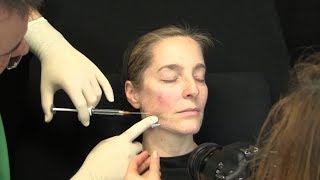 Liquid Facelift – Video Unterspritzung mit Hyaluronsäure – Zeitraffer Facelift ohne OP [upl. by Nomzaj]