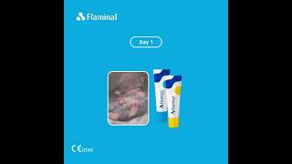 Flaminal® in the treatment of a Pressure Ulcer [upl. by Accalia]