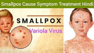 Smallpox Variola Cause Symptoms Diagnosis Treatment in Hindi  Smallpox Hindi  What is Smallpox [upl. by Halda490]