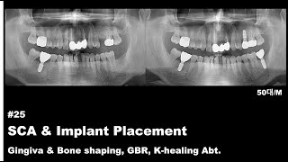 25 SCA amp Implant Placement Gingiva amp Bone shaping GBR Khealing Abt [upl. by Maison686]