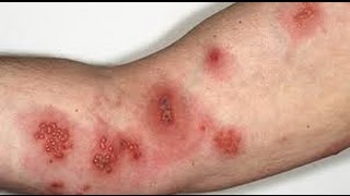 How to cure shingles in 3 days [upl. by Assina]