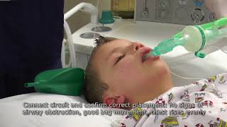 Paediatric Anaesthetics Chapter 2  LMA insertion 1 [upl. by Nevs691]