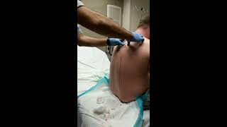 Large cyst Bursts out mans back Viewer beware [upl. by Trabue]