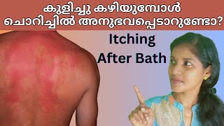 How To Stop Itching After Bath  വെള്ളം ശരീരത്തിൽ കൊണ്ടാൽ ചൊറിച്ചിൽ  Malayalam [upl. by Nhor238]