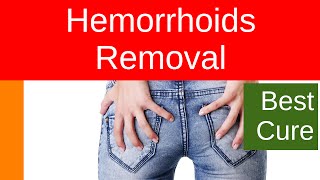 Hemorrhoids Removal [upl. by Paula]