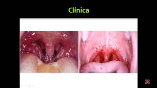 Faringoamigdalitis Agentes infecciosos Dx diferencial Viralbacteriana Tratamiento Infectología [upl. by Abibah]