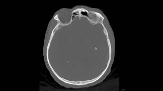 Stroke Hypertensive haemorrhage  radiology video tutorial MRI CT [upl. by Torrell]