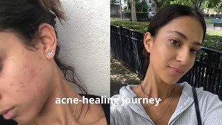 grwm while i tell you about my acne healing journey [upl. by Edras99]