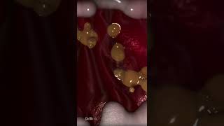 What Can Cause Stomach Ulcers Animation animation science 3danimation love biology film new [upl. by Lokkin]