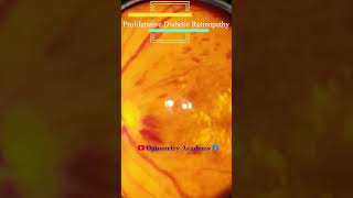 Diabetic retinopathy  Hemorrhages  proliferative diabetic retinopathy PDR  Short Video 181 [upl. by Yseulte]