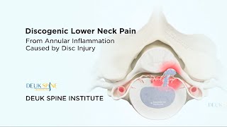 Discogenic Neck Pain  3D Animation [upl. by Alle840]