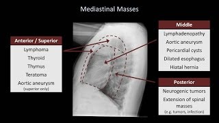 How to Interpret a Chest XRay Lesson 5  Cardiac Silhouette and Mediastinum [upl. by Cardie]