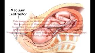 Nuchal Cord Vacuum Extraction [upl. by Forest134]