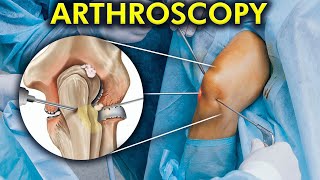 The World of Arthroscopic Surgery How Arthroscopy is performed Include 3d animation [upl. by Brice]