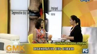 Degenerative Disc Disease [upl. by Yves]