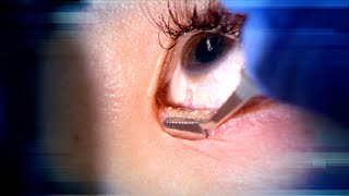 Watch as Woman Undergoes Procedure to Remove Eyelid Puss [upl. by Debora]