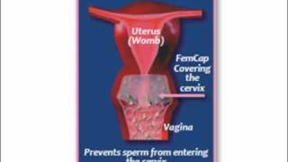 What is the FemCap Cervical Cap [upl. by Meehyrb]