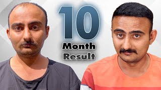 4000 Grafts  Before After Hair Transplant Results 29 years  Grade 5  6  Dr Vivek Galani  RQC [upl. by Newbold834]