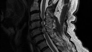 MRCP PACES Long Clinical Consultation Myelopathy New Format [upl. by Ovid773]