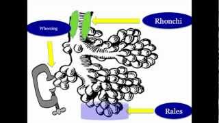 Abnormal Lung Sounds [upl. by Rahal]