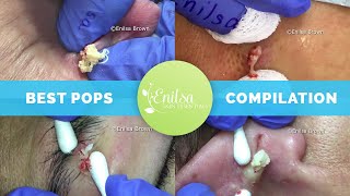 Enilsas Top 5 Best Cyst Popping Compilation [upl. by Larissa334]