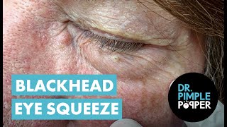 Blackhead Eye Squeeze [upl. by Lorollas]