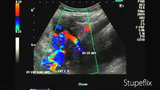 Color Doppler video of uterine artery in 2nd trimester [upl. by Eniahpets393]