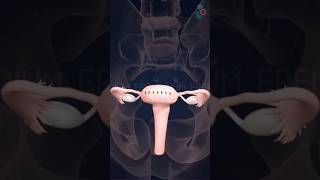 Laparoscopic Myomectomy Surgery ↪ 3D Medical Animation LaparoscopicMyomectomy Surgery [upl. by Adiol]