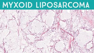 Myxoid liposarcoma high grade formerly round cell liposarcoma AIP France 2021 [upl. by Behre]