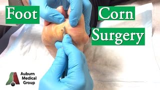 Foot Corn Surgery Treatment [upl. by Lexy]