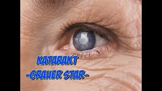 Erkrankungen der Augen  Katarakt oder grauer Star [upl. by Dixil]