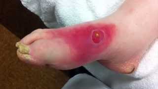 diabetic cellulitis [upl. by Aikemat]